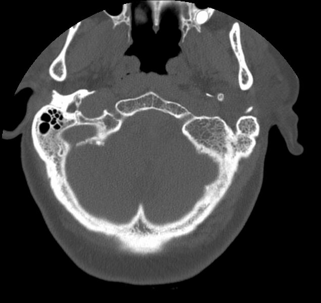File:Atlanto-occipital assimilation with basilar invagination (Radiopaedia 70122-80188 Axial bone window 6).jpg