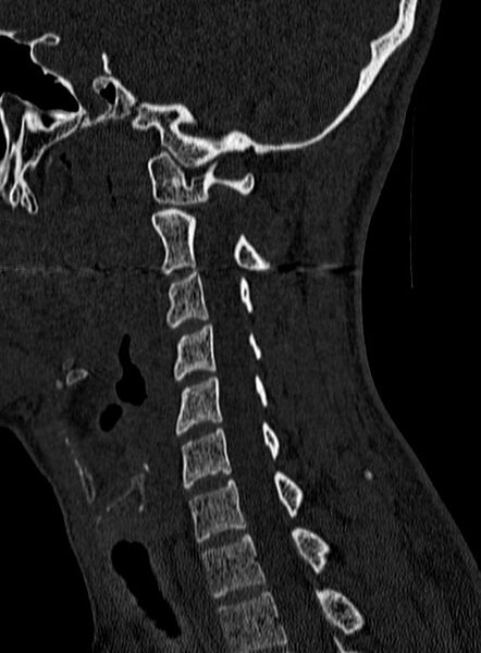 File:Atlantoaxial subluxation (Radiopaedia 44681-48450 Sagittal bone window 100).jpg