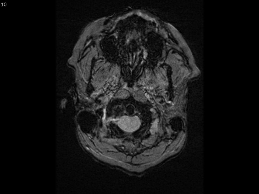 Atypical meningioma - intraosseous (Radiopaedia 64915-74572 Axial SWI 10).jpg