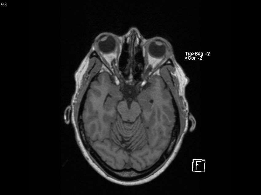 Atypical meningioma - intraosseous (Radiopaedia 64915-74572 Axial T1 93).jpg