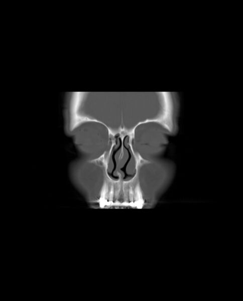 File:Automastoidectomy with labyrinthine fistula (Radiopaedia 84143-99411 Coronal non-contrast 9).jpg