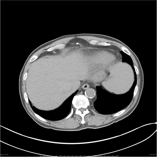 File:Autosomal dominant polycystic kidney disease (Radiopaedia 27835).jpg