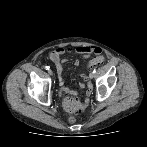 File:Autosomal dominant polycystic kidney disease (Radiopaedia 27851-28094 B 109).jpg