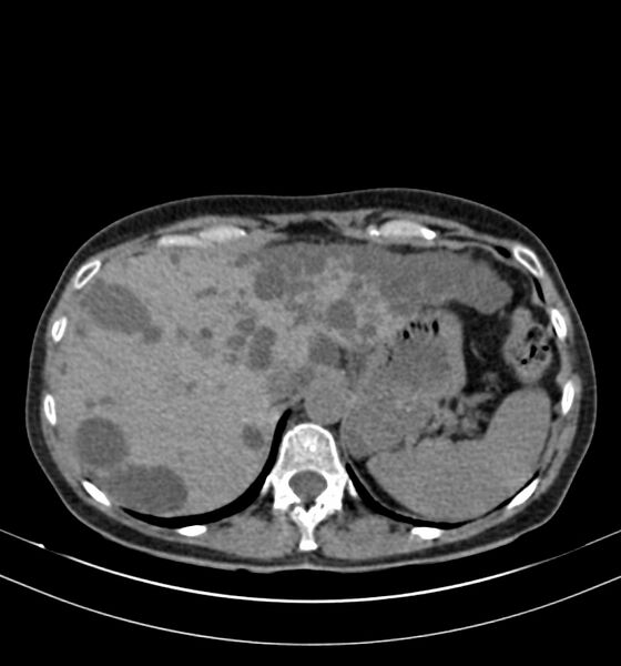 File:Autosomal dominant polycystic kidney disease (Radiopaedia 41918-44922 Axial non-contrast 4).jpg