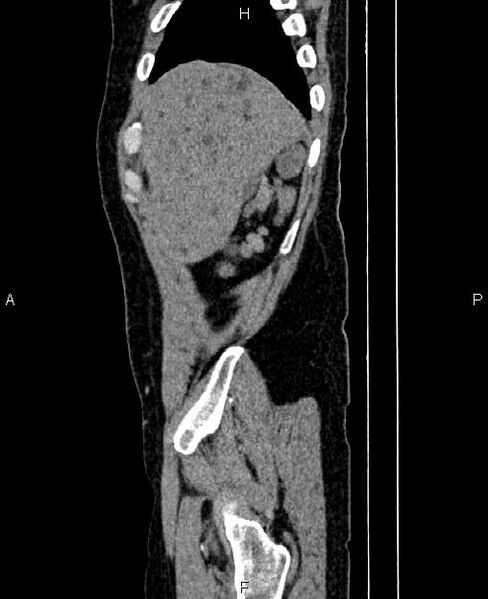 File:Autosomal dominant polycystic kidney disease (Radiopaedia 87830-104287 C 7).jpg