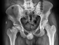 Avascular necrosis of the hip joint (Radiopaedia 62708).PNG