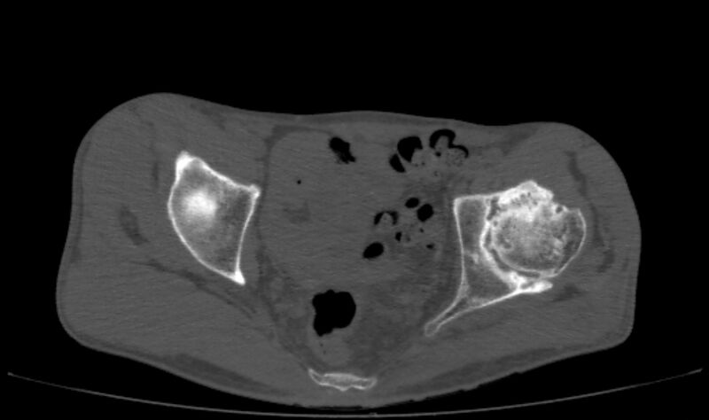 File:Avascular necrosis of the left hip (Radiopaedia 75068-86125 Axial bone window 30).jpg