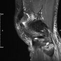 Avulsion fracture of the fibular head (Radiopaedia 74804-85808 Sagittal PD fat sat 28).jpg