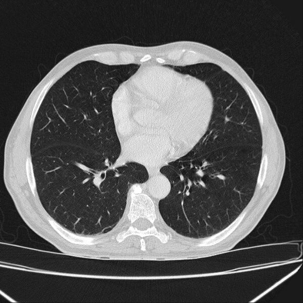 File:Azygos lobe (Radiopaedia 38259-40275 Axial lung window 51).jpg