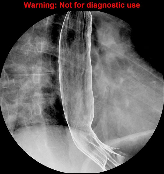 File:Barrett esophagus (Radiopaedia 44421-48075 A 8).jpg