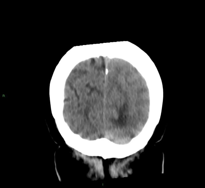 Basal ganglia hemorrhage (Radiopaedia 58759-65981 Coronal non-contrast 16).jpg