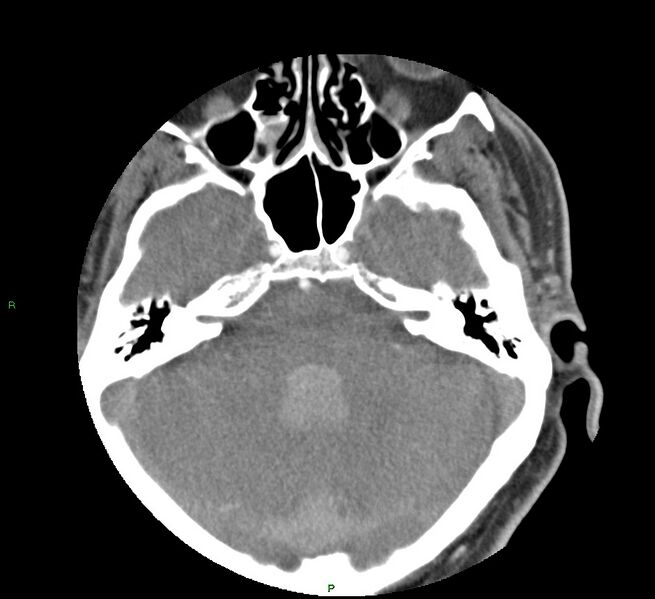 File:Basal ganglia hemorrhage (Radiopaedia 58763-65985 D 52).jpg