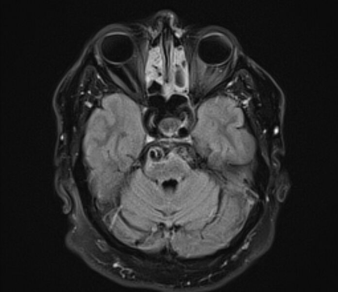 File:Basilar artery dissection (Radiopaedia 77032-88976 Axial FLAIR 8).jpg