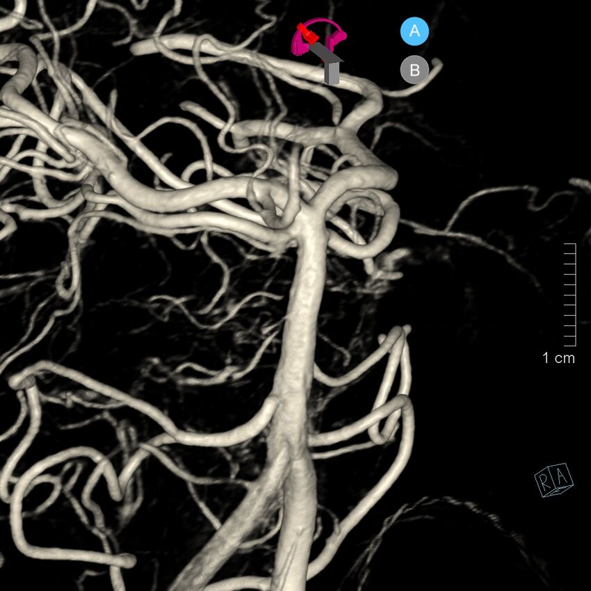 Basilar artery perforator aneurysm (Radiopaedia 82455-97734 3D view left VA 52).jpg