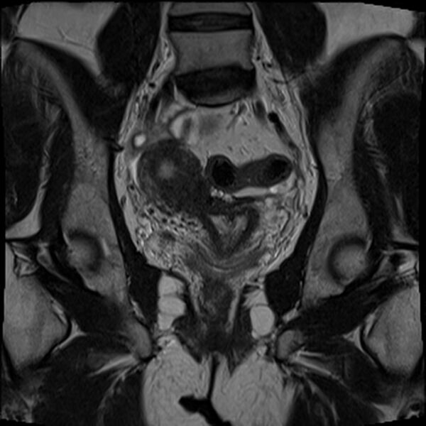 File:Bicornuate, unicollis uterus (Radiopaedia 79468-92593 Coronal T2 14).jpg