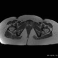 Bicornuate uterus- on MRI (Radiopaedia 49206-54297 Axial T1 16).jpg