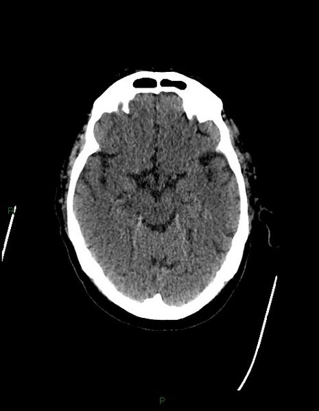 File:Bilateral acute middle cerebral artery territory infarcts (Radiopaedia 77319-89401 Axial non-contrast 34).jpg