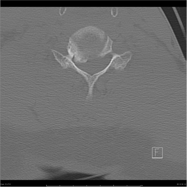 File:Bilateral cervical ribs (Radiopaedia 25868-26017 Axial bone window 35).jpg