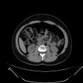 Bilateral ovarian mature cystic teratomas (Radiopaedia 79373-92457 Axial non-contrast 29).jpg
