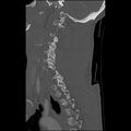 Bilateral perched facets with cord injury (Radiopaedia 45587-49713 Sagittal bone window 38).jpg