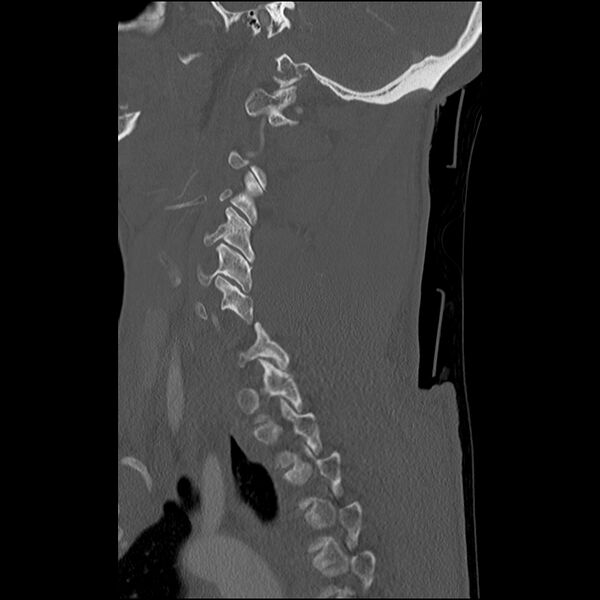 File:Bilateral perched facets with cord injury (Radiopaedia 45587-49713 Sagittal bone window 38).jpg