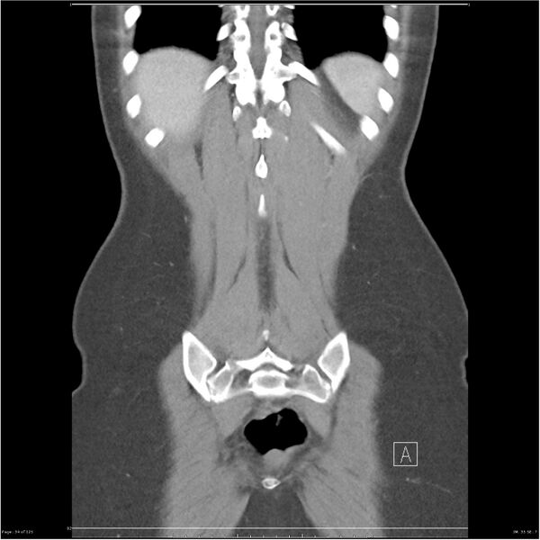 File:Bilateral ureteritis and cystitis (Radiopaedia 25340-25594 B 34).jpg