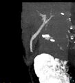 Bile leak from accessory duct(s) of Luschka post cholecystectomy (Radiopaedia 40736-43389 D 26).jpg