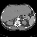 Biliary necrosis - liver transplant (Radiopaedia 21876-21845 A 15).jpg
