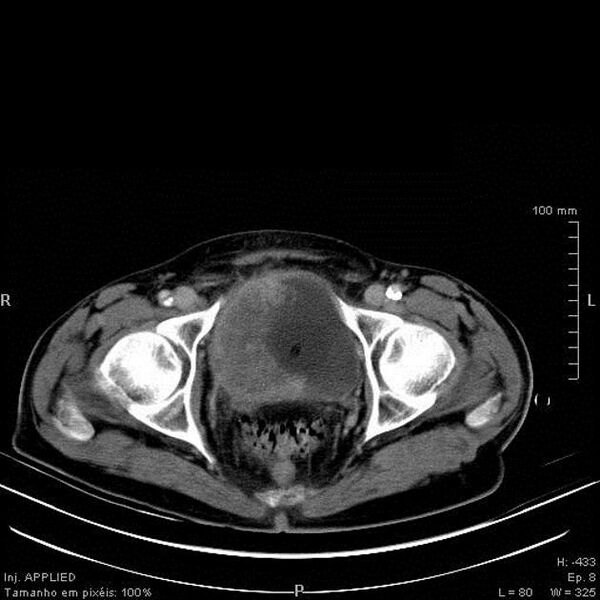 File:Bladder squamous cell carcinoma (Radiopaedia 14130-13984 B 10).jpg