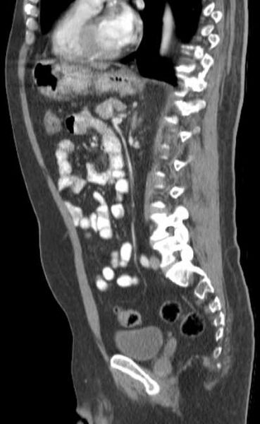 File:Bleeding duodenal ulcer and adenomyomatosis of gallbladder (Radiopaedia 61834-69861 C 59).jpg