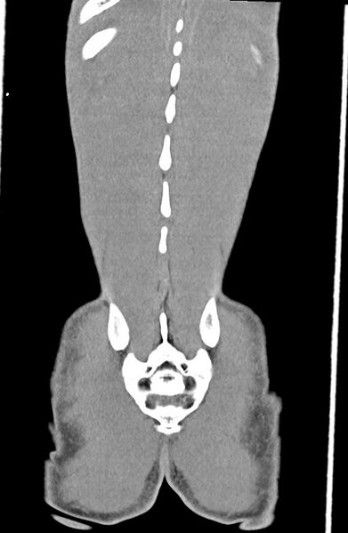 File:Blunt injury to the small bowel (Radiopaedia 74953-85987 B 88).jpg