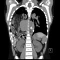 Bochdalek diaphragmatic hernia (Radiopaedia 38866-41059 Coronal liver window 14).jpg
