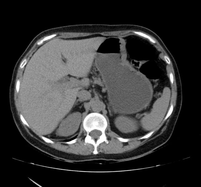 File:Bosniak renal cyst - type IV (Radiopaedia 22929-22953 Axial non-contrast 13).jpg