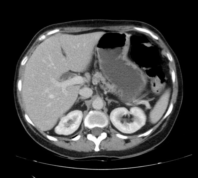 File:Bosniak renal cyst - type IV (Radiopaedia 22929-22953 C 14).jpg