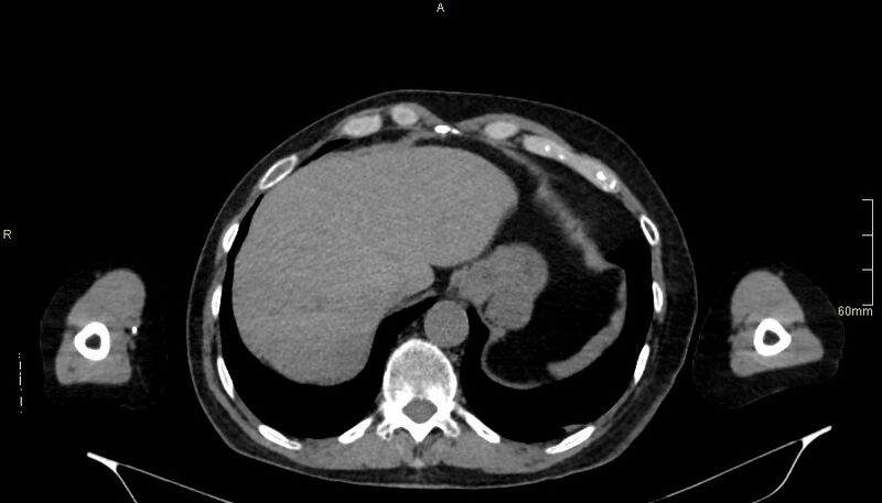 File:Brachial artery foreign body (Radiopaedia 54583-60820 Axial non-contrast 54).jpg