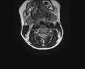 Brachial plexus birth palsy (Radiopaedia 68118-77604 Axial T2 7).jpg