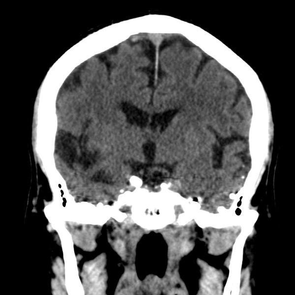 File:Brain Pantopaque remnants (Radiopaedia 78403-91048 Coronal non-contrast 34).jpg