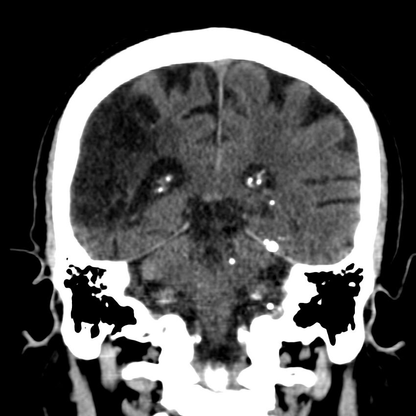 Brain Pantopaque remnants (Radiopaedia 78403-91048 Coronal non-contrast 46).jpg