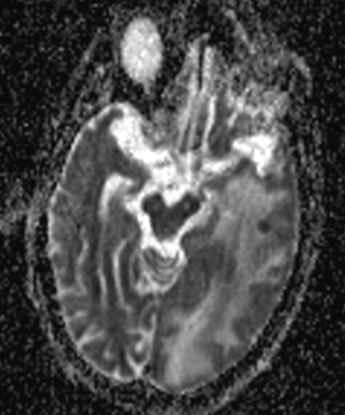 File:Brain abscess with dual rim sign (Radiopaedia 87566-103938 Axial ADC 7).jpg