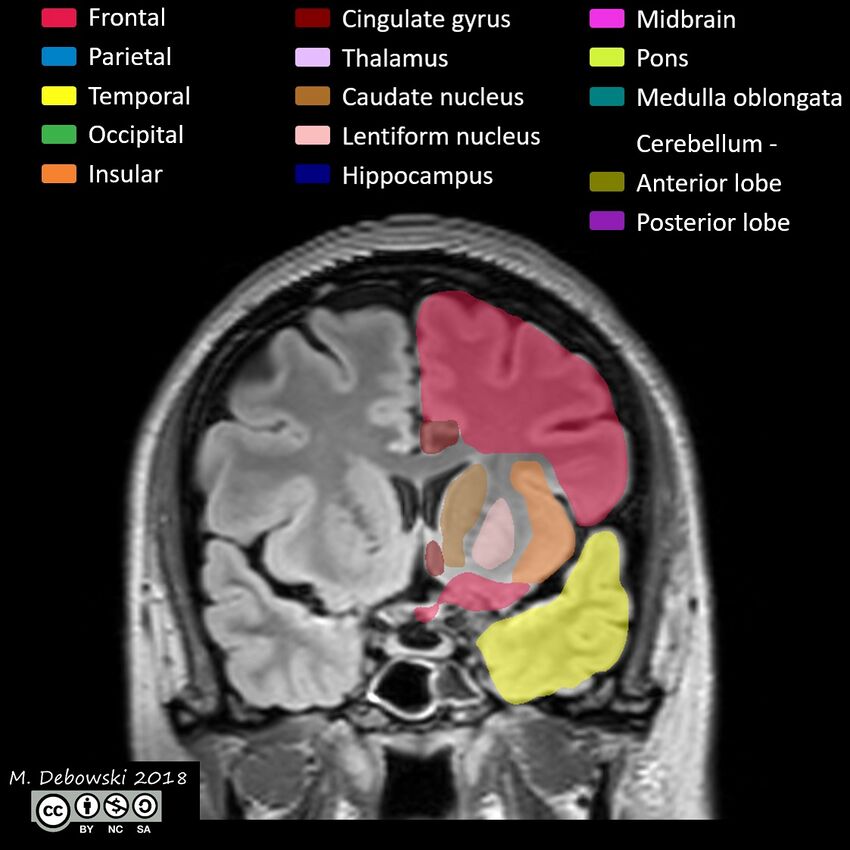 Brain lobes - annotated MRI (Radiopaedia 61691-69700 Coronal 25).JPG