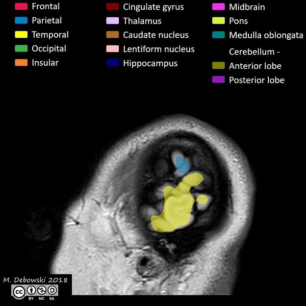 File:Brain lobes - annotated MRI (Radiopaedia 61691-69700 Sagittal 79).JPG
