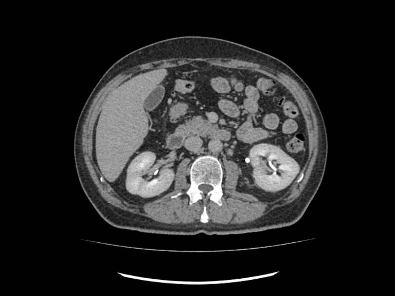 File:Brain metastases from renal cell carcinoma (Radiopaedia 42222-45328 Axial C+ delayed 96).jpg