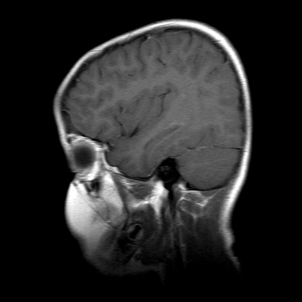 File:Brainstem ganglioglioma (Radiopaedia 10763-11224 Sagittal T1 C+ 5).jpg