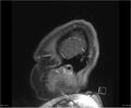 Brainstem glioma (Radiopaedia 21819-21775 D 2).jpg