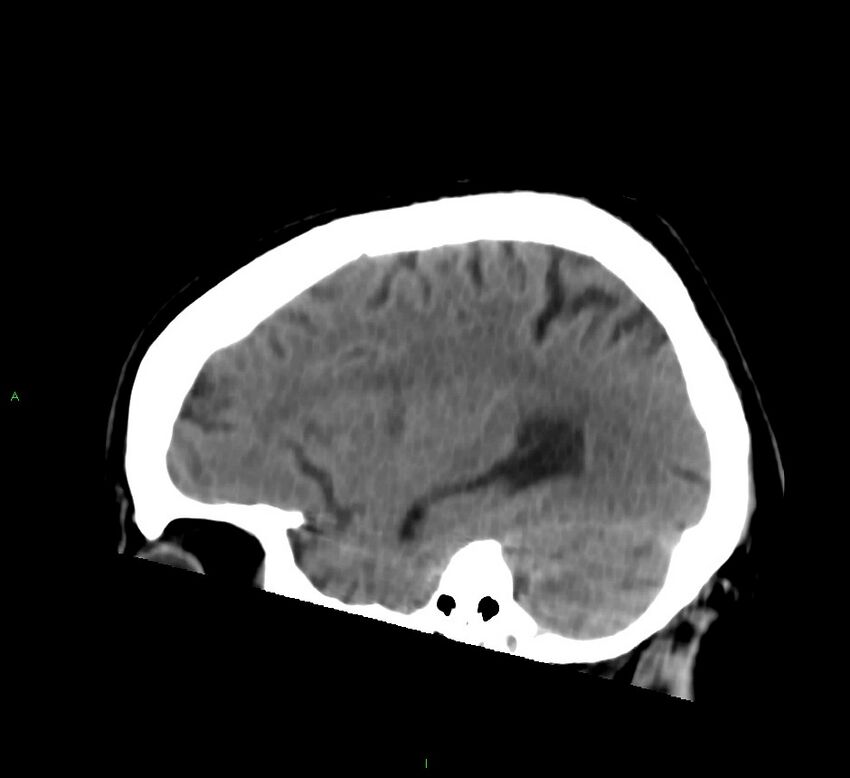 Brainstem hemorrhage (Radiopaedia 58794-66028 C 37).jpg