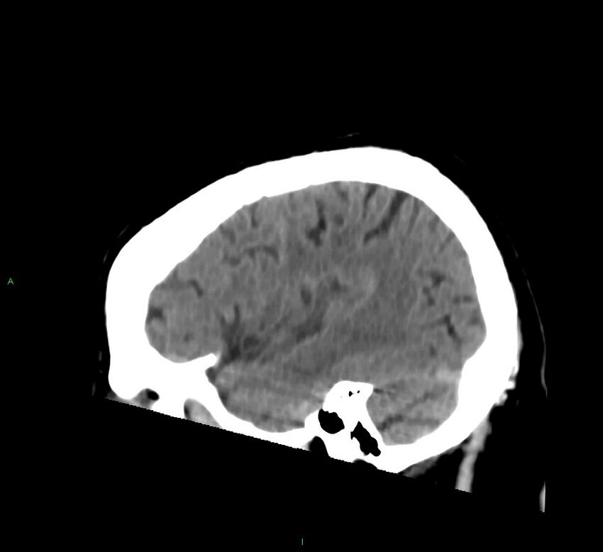 Brainstem hemorrhage (Radiopaedia 58794-66028 C 40).jpg