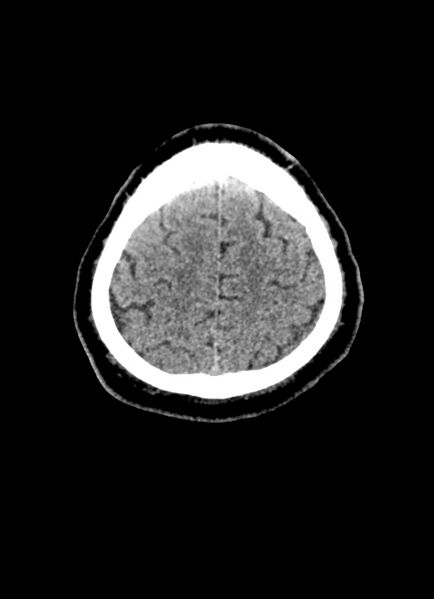 File:Brainstem hemorrhage (Radiopaedia 81294-94976 Axial non-contrast 13).jpg