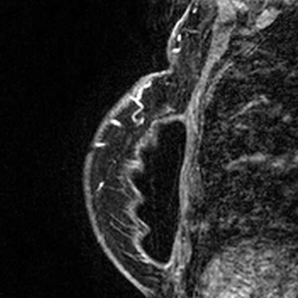 File:Breast implants - MRI (Radiopaedia 26864-27035 Sagittal T2 86).jpg