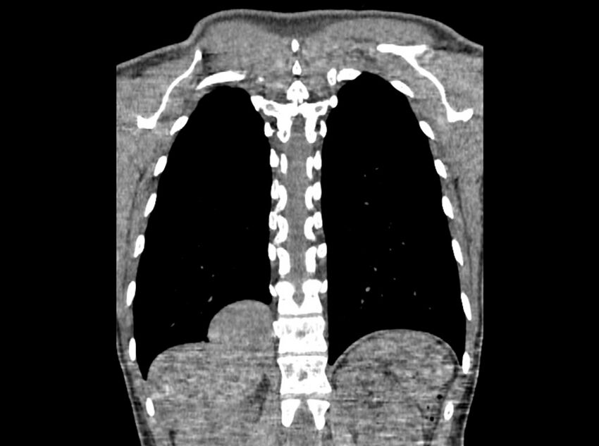 Bronchogenic cyst (Radiopaedia 80273-93615 D 103).jpg