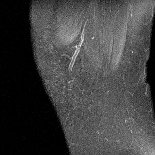 File:Bucket handle tear - medial meniscus (Radiopaedia 79028-91942 Sagittal PD fat sat 25).jpg